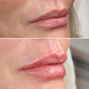 6-POINT LIP LIFT