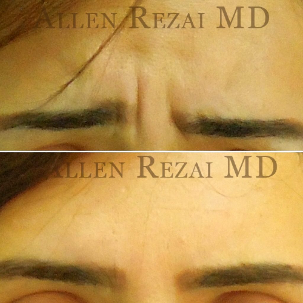 ANTI WRINKLE INJECTIONS – FROWN LINES