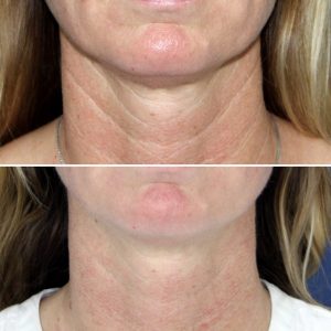 NECK REJUVENATION WITH INJECTABLES