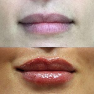 6-POINT LIP LIFT