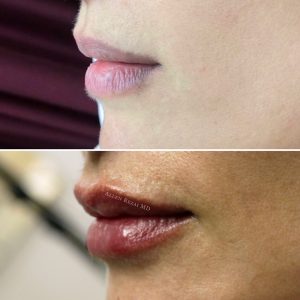 6-POINT LIP LIFT