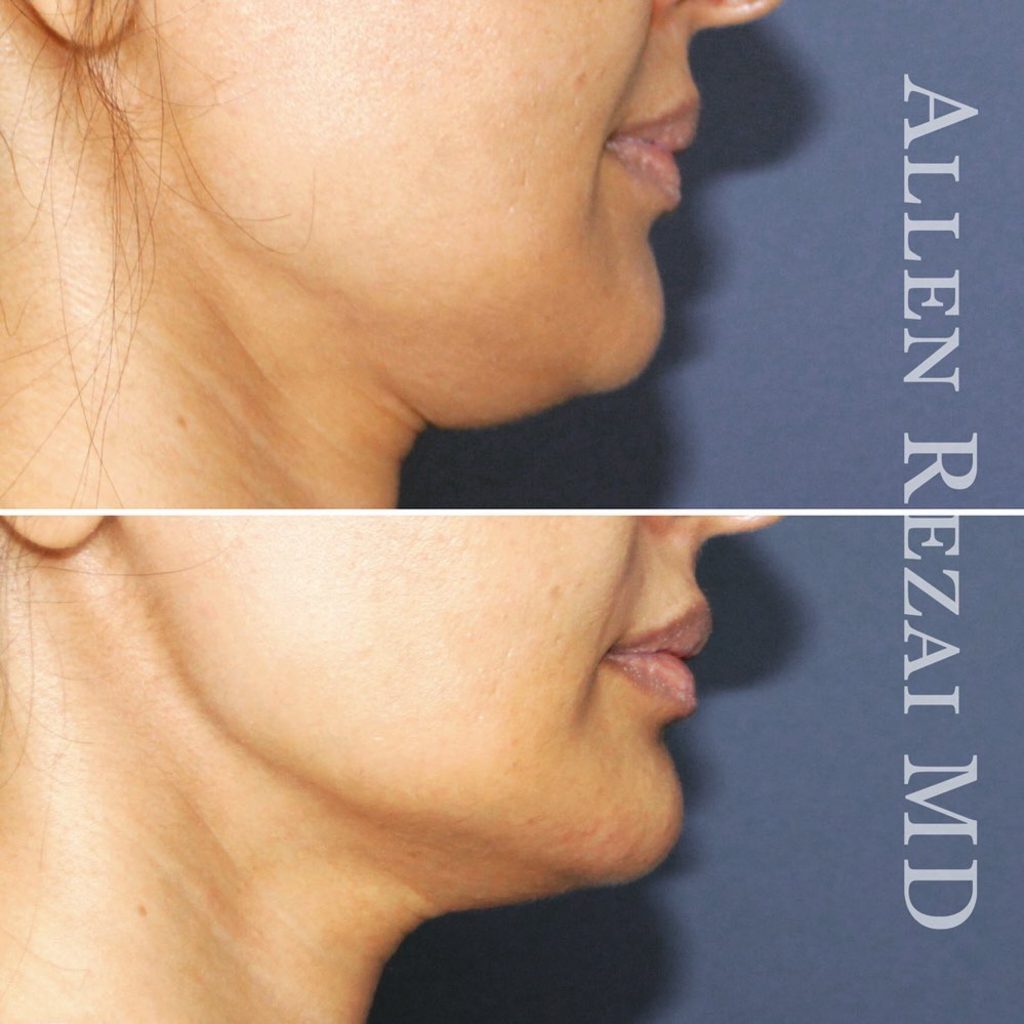 3D FACE CONTOURING WITH FILLERS