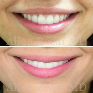 GUMMY SMILE CORRECTION