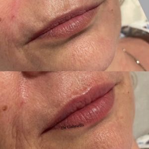 LIP FILLER TREATMENT