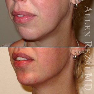 3D FACE CONTOURING WITH FILLERS