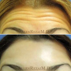 ANTI WRINKLE INJECTIONS – FOREHEAD