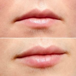 6-POINT LIP LIFT