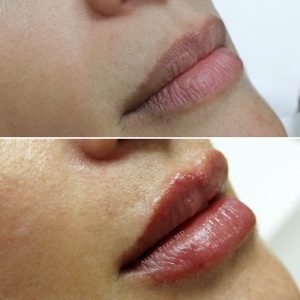 6-POINT LIP LIFT