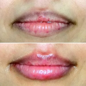 6-POINT LIP LIFT