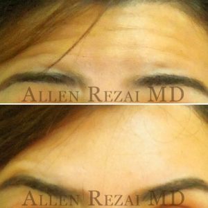 ANTI WRINKLE INJECTIONS – FOREHEAD LINES