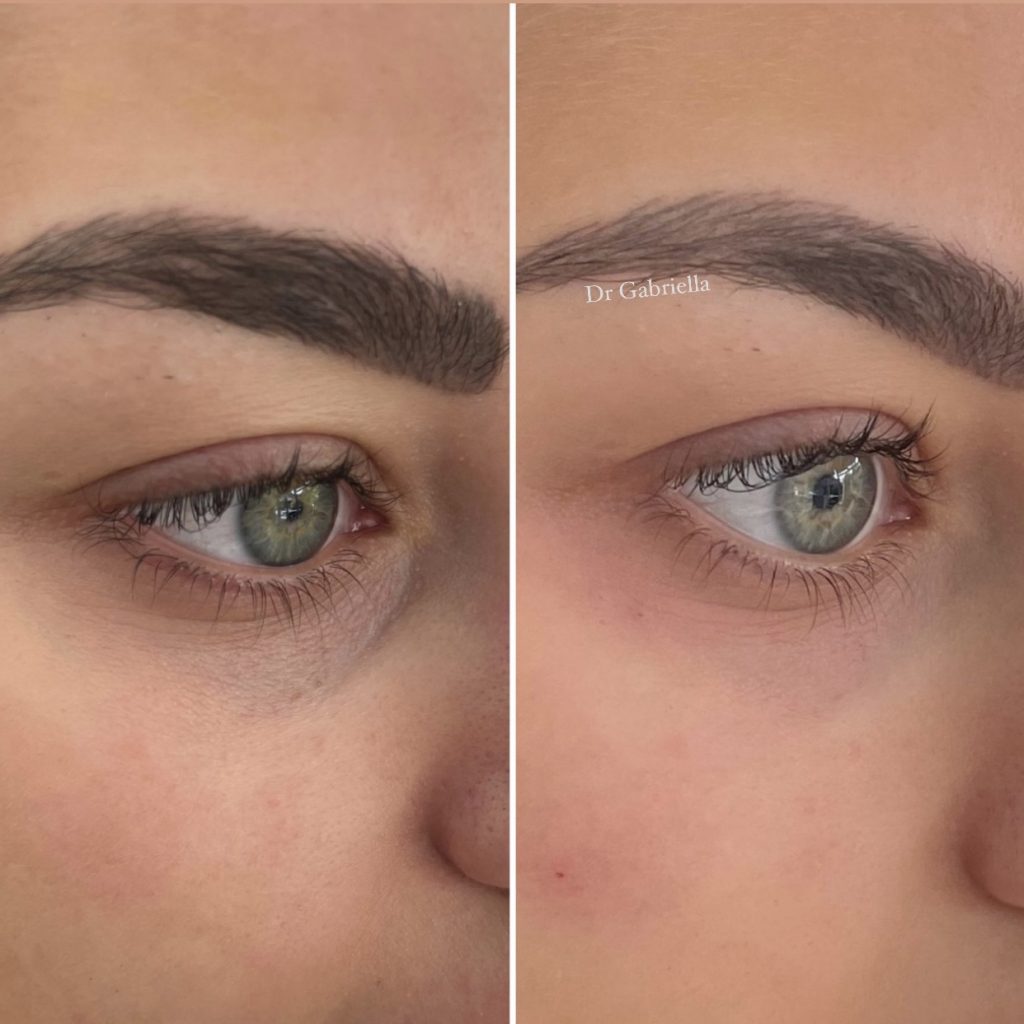 TEAR TROUGH FILLER