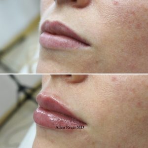 6-POINT LIP LIFT