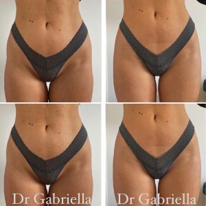 HIP DIP CORRCETION / BUTTOCK ENHANCEMENT