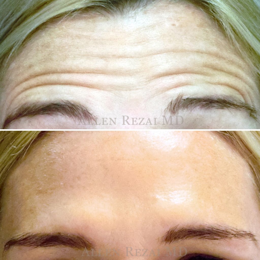 ANTI WRINKLE INJECTION – FOREHEAD