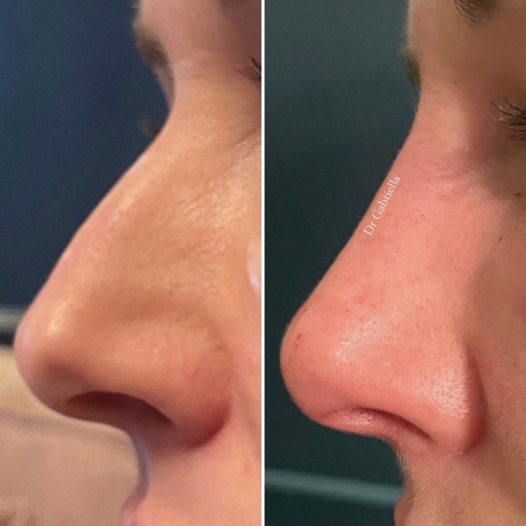 NON SURGICAL NOSE RESHAPING