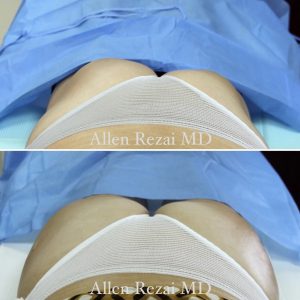 BUTTOCK ENHANCEMENT / HIP DIP CORRECTION