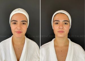 Before & Immediately After Hydrafacial