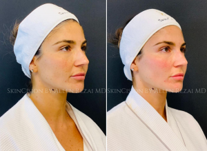 Before & Immediately After Bespoke Facial