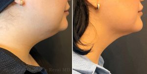 Before and 10 Months After FaceTite of the Mid- and Lower Face & Neck + Morpheus8 Gold