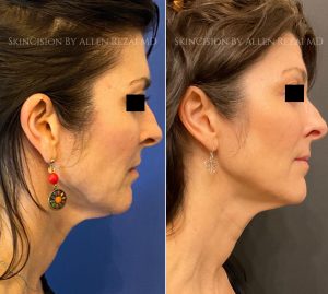 Before and 5-Weeks After 1st Session of Morpheus8 Gold for the Face & Neck