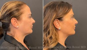 Before and 5 Weeks After FaceTite of the Mid- and Lower Face & Neck + Morpheus8 Gold