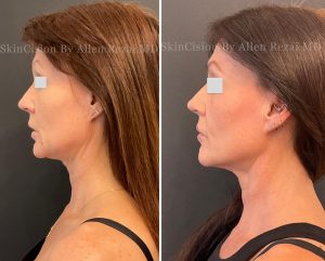 Before and 6-Months After 3rd Session of Morpheus8 Gold for the Face & Neck